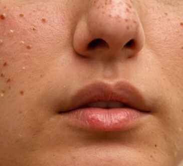 Ursachen und effektive Behandlungsmethoden für Pickel auf der Nase