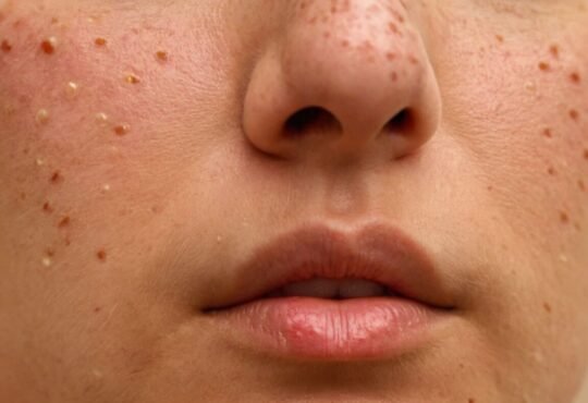 Ursachen und effektive Behandlungsmethoden für Pickel auf der Nase